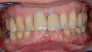 Pathologie dentaire classe II